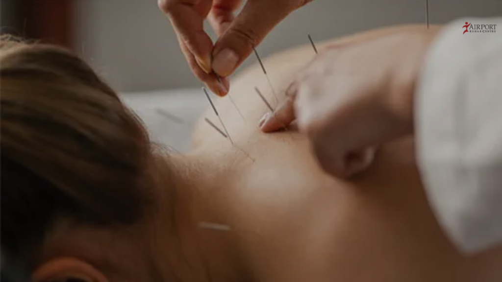 ACUPUNCTURE