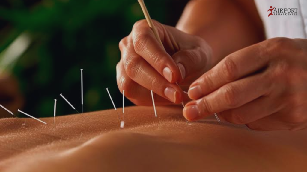 ACUPUNCTURE